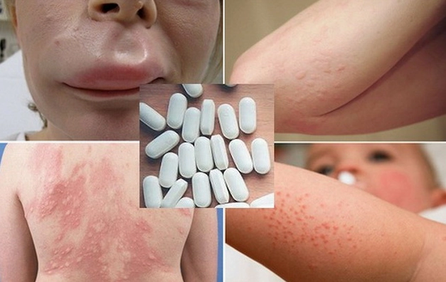 Dị Ứng Thuốc Aspirin: Triệu Chứng, Nguyên Nhân và Cách Điều Trị Hiệu Quả