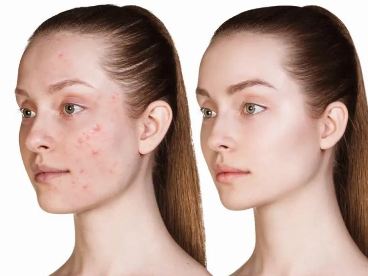 Salicylic acid là gì? Điều trị mụn thế nào?