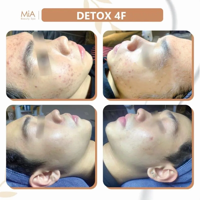 Top 6 Địa chỉ spa trị mụn chất lượng nhất tại Quận 6, TP.HCM